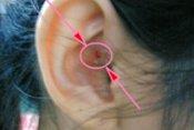 宝宝耳朵上有个小洞!耳前瘘管——妈妈容易遗漏的育儿细节