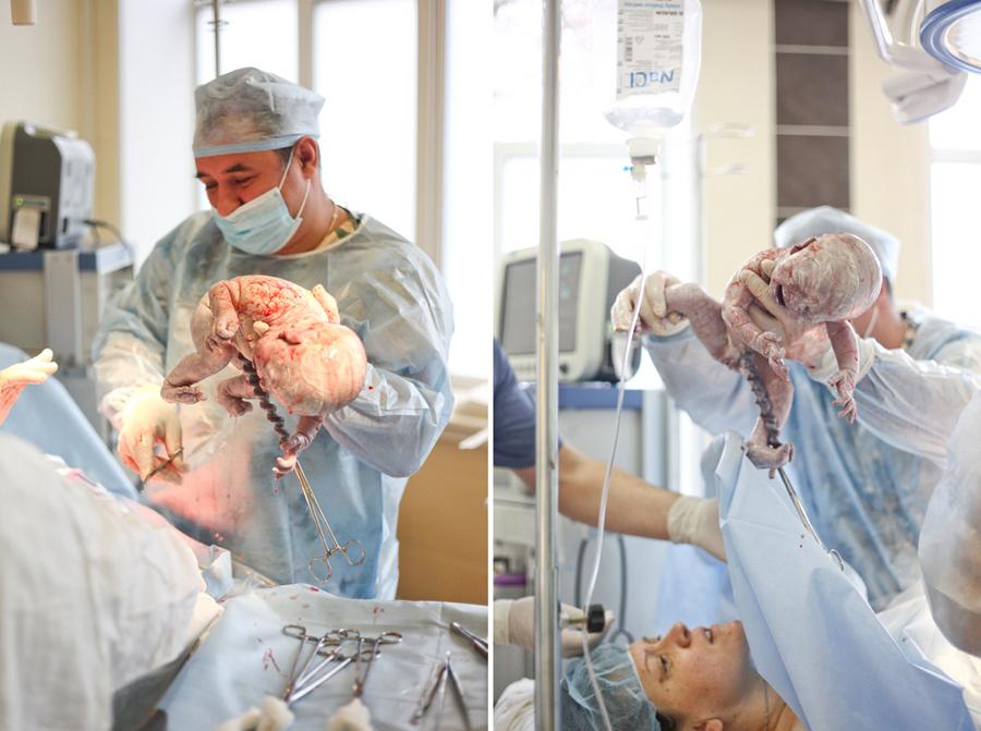 【产妇参考】剖腹产分娩手术全过程(转帖)