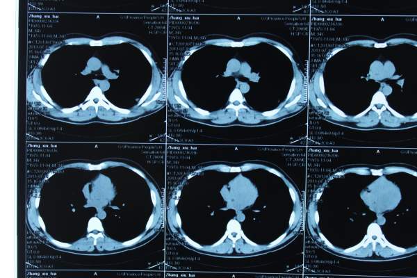 麻煩幫看下肺部ct片,是不是癌症的症狀?不勝感激!