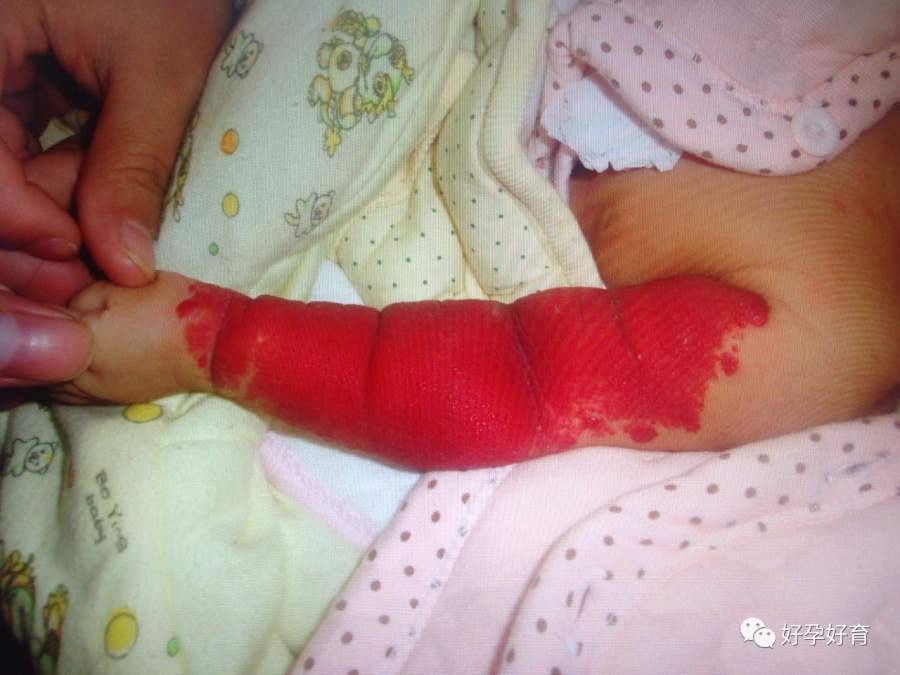 不幸刚出生10天的宝宝一只手臂全变成了红色