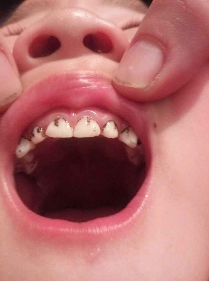 3岁宝宝的牙黑问题